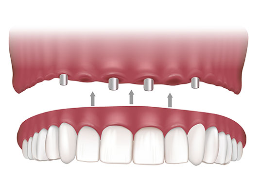 The image shows a close-up view of an open mouth with an implant being placed into the upper jaw, illustrating the process of dental implantation.