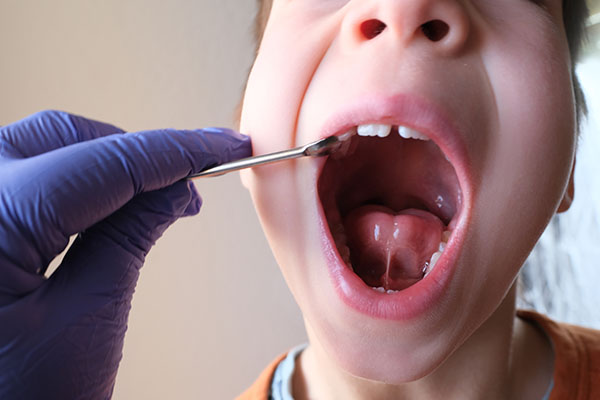 The image shows a young child with an open mouth receiving dental care, where a dental professional appears to be performing a procedure on their teeth using a drill, with the child wearing a protective eyewear, all set against a plain background.