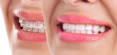 The image displays a woman with a bright smile looking directly at the camera, showcasing her teeth, which are enhanced with cosmetic dental work, against a plain background.