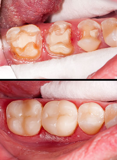 The image shows two photos of an open mouth with visible dental decay and gum disease, highlighting oral health issues.