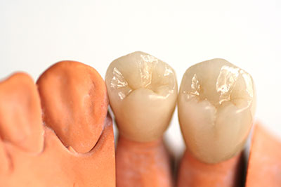 An image showcasing three sets of human teeth with visible dental implants.