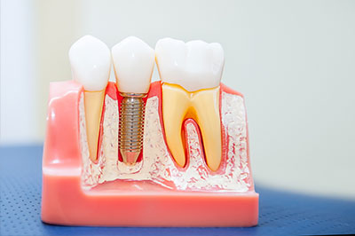 The image shows a model of a human mouth with artificial teeth and a dental implant, displayed on a pink base for educational purposes.