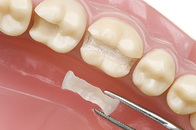 An image showing a close-up view of a dental implant procedure with a screw visible through the gum tissue, placed on a pink dental tray.