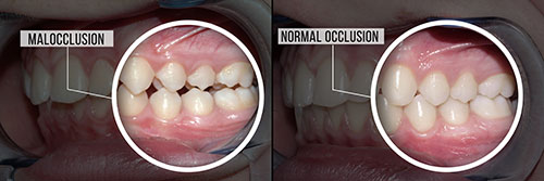 The image shows two photographs side by side of a person s teeth with annotations pointing to different areas of the mouth, likely for educational purposes related to dental care or oral health issues.