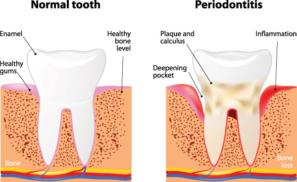 The image depicts three stages of gum disease progression from normal to periodontitis, with annotations explaining the differences between healthy bone, inflammation, and advanced decay.