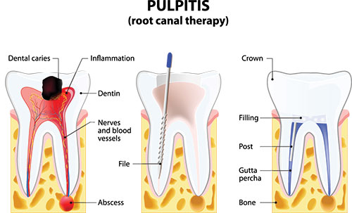 The image shows a diagrammatic illustration of a dental implant procedure, featuring anatomical details such as teeth, gums, bone tissue, and surgical tools, with labels indicating  root canal therapy,   dental caries,   inflammation,   crown,  and other medical terms.