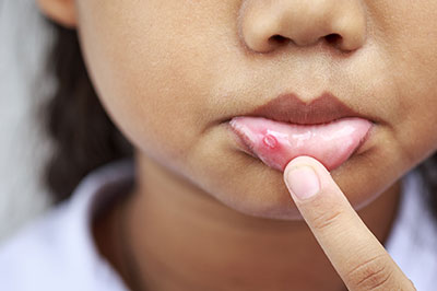 The image shows a close-up of a young person s face with acne, pointing at their nose with an index finger.