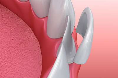 The image shows a close-up view of a dental implant with a visible screw on top, set against a pinkish background that resembles gum tissue.