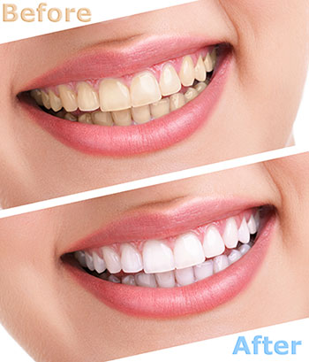 The image shows a side-by-side comparison of a person s teeth before and after dental treatment, highlighting the results of teeth whitening.