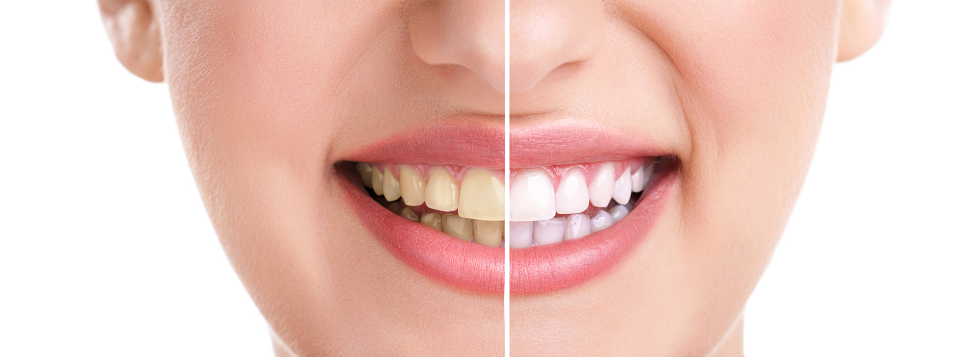 The image shows a smiling woman with a focus on her teeth, which are highlighted by a bright light, suggesting an advertisement for dental care products or services.