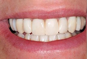 The image shows a close-up of a person s smile with straight white teeth and red gums, against a neutral background.