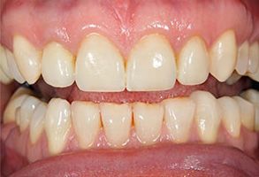 The image shows a close-up view of a person s teeth with a focus on the front teeth, which appear yellowed and stained.