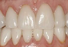 The image displays a close-up view of a person s teeth with visible plaque and staining, emphasizing oral hygiene concerns.
