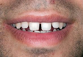 The image shows a close-up of a person s smiling face with teeth that are missing their front teeth.