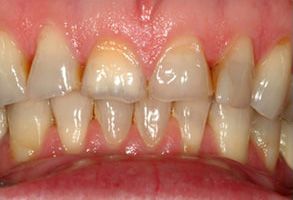 The image shows a close-up view of a person s teeth with yellow stains and uneven wear, likely indicating poor oral hygiene.